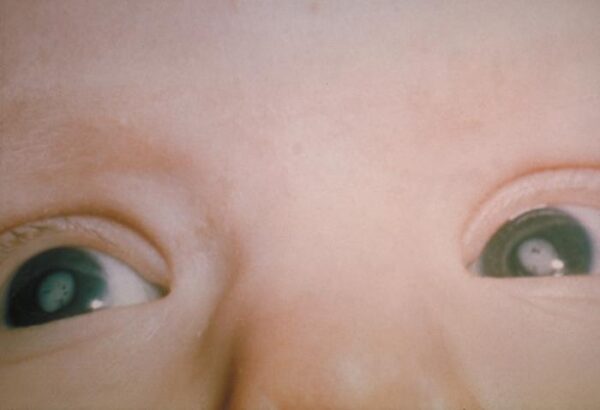 Congenital cataracts caused by congenital rubella syndrome