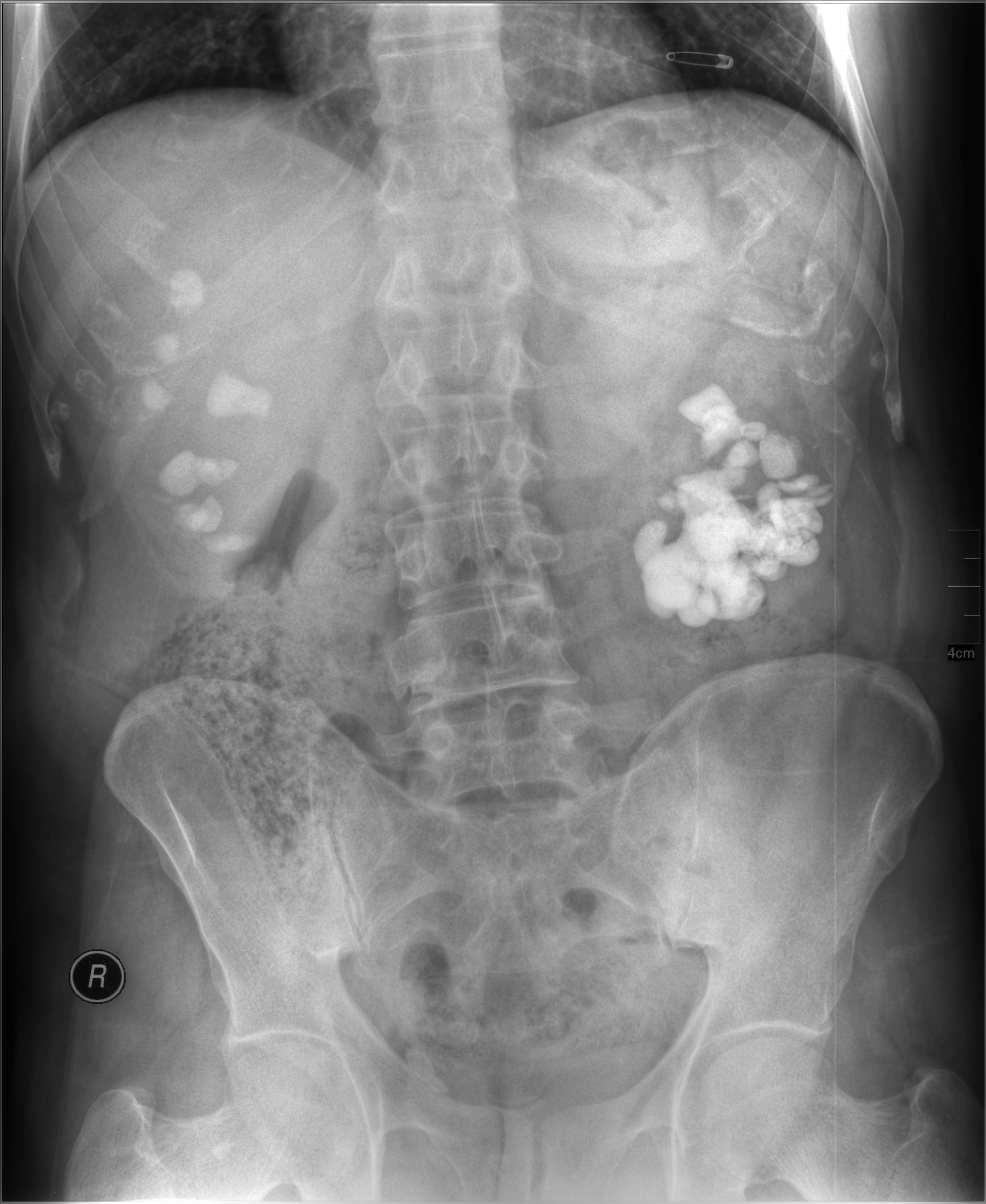staghorn calculus right kidney
