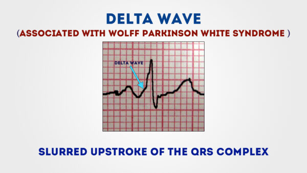 ECG - Delta wave (Wolff Parkinson White Syndrome)