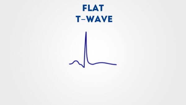 Flattened T wave