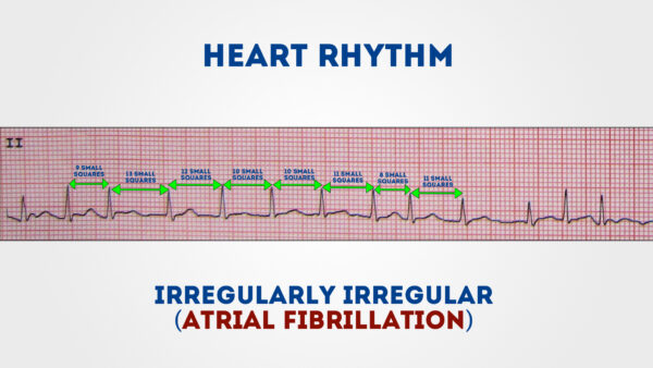 ECG Heart Rhythm