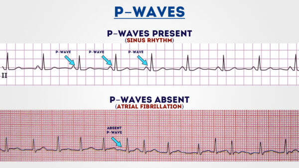 ECG - atrial fibrillation - p waves