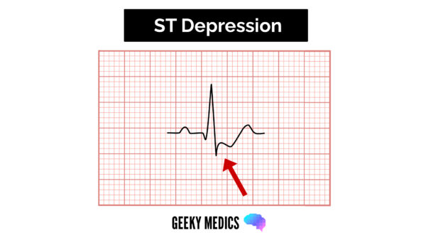 ECG ST depression