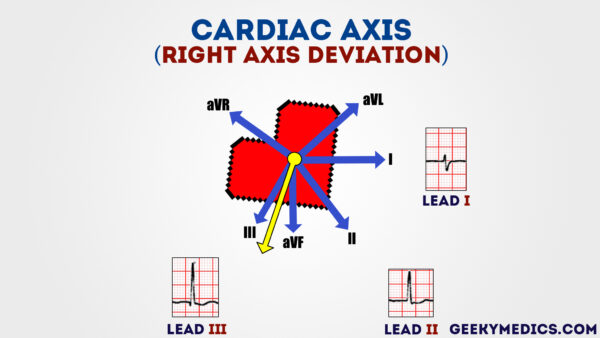 ECG - Right axis deviation