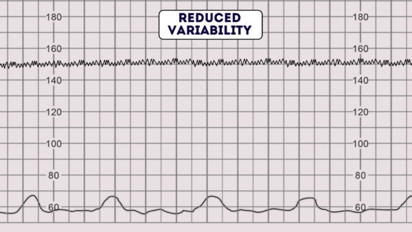 CTG - Reduced Variability