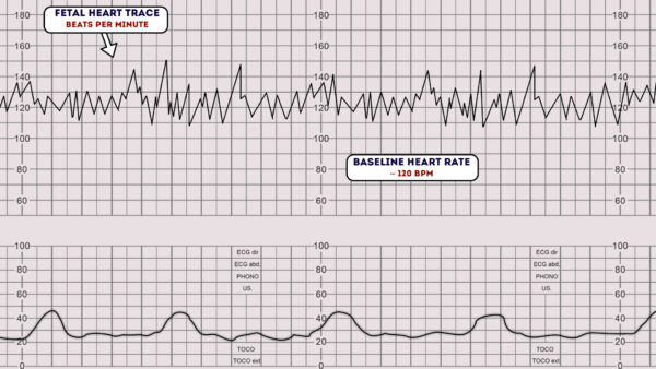 Fetal heart rate CTG