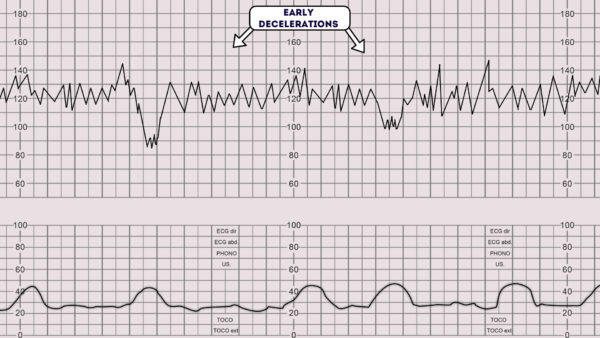 CTG - Early Decelerations