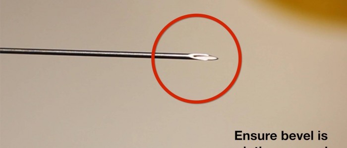 Venepuncture procedure