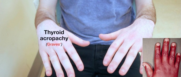 Thyroid acropachy