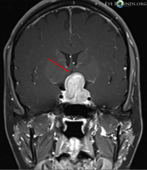 Post-contrast T1 brain MRI, coronal view, showing a pituitary adenoma with elevation and compression of the optic chiasm (arrow indicates area of optic chiasm)