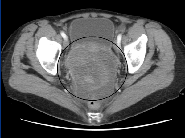 CT showing large ovarian tumour in the pelvis 