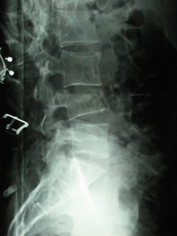 L4 wedge fracture