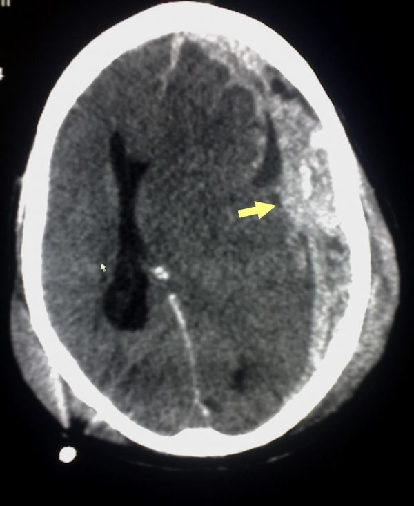 CT head subdural haematoma