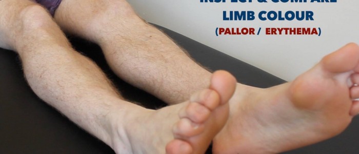 Diabetic Foot Examination - OSCE Guide | Geeky Medics