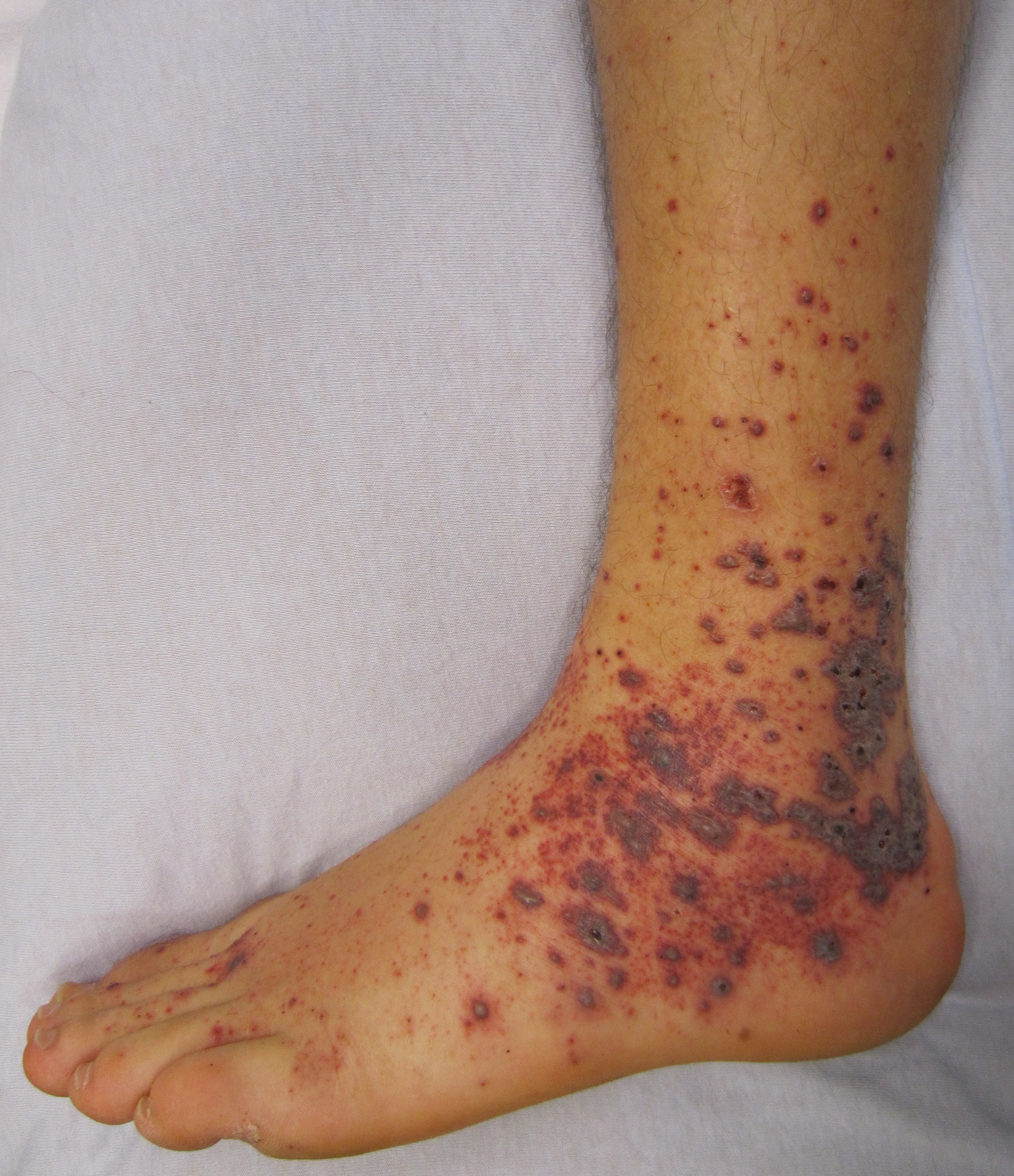 What are some visual characteristics of scabies rash?