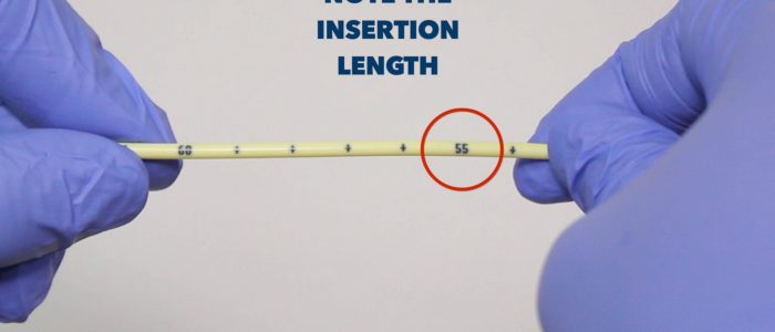 NG tube insertion