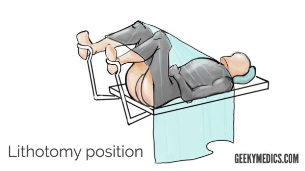 Lithotomy position