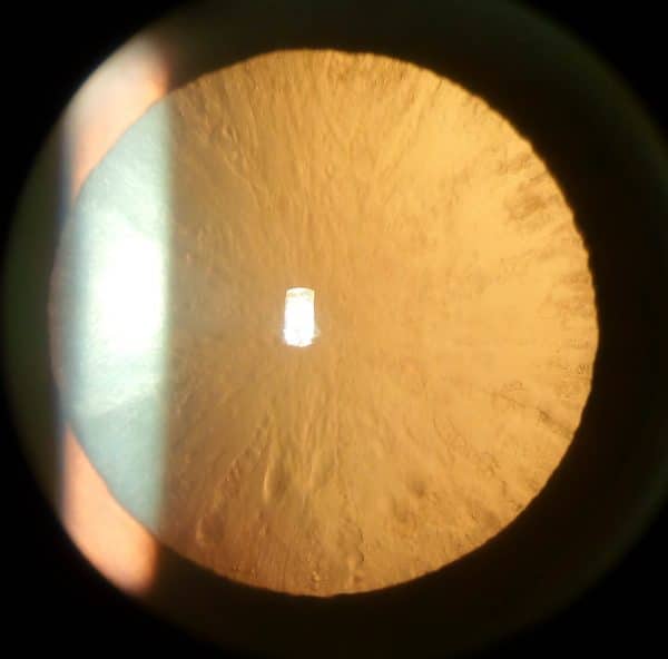 Cortical cataract