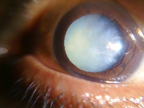 Mature cataracts with loss of red reflex