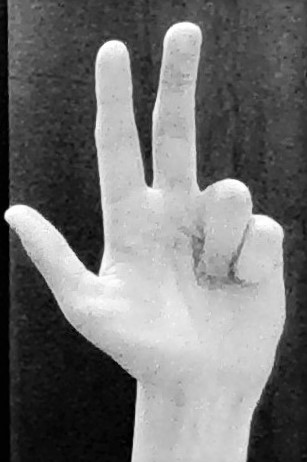 hand of benediction deformity