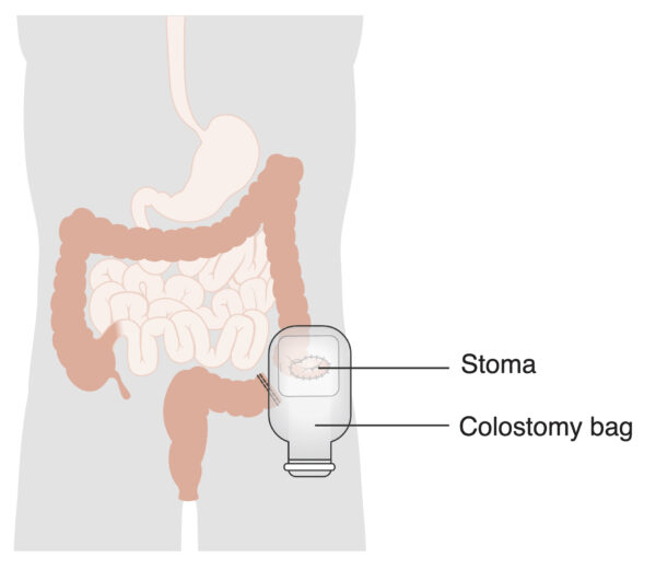 Types of stomas - colostomy