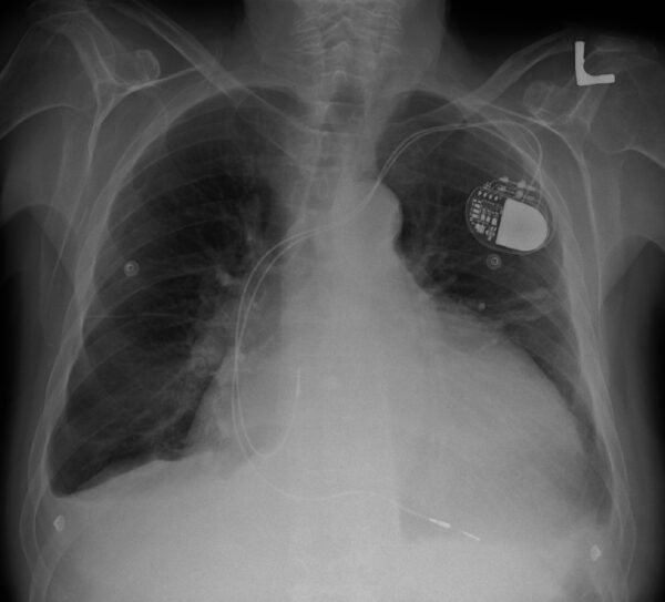 Cardiomegaly