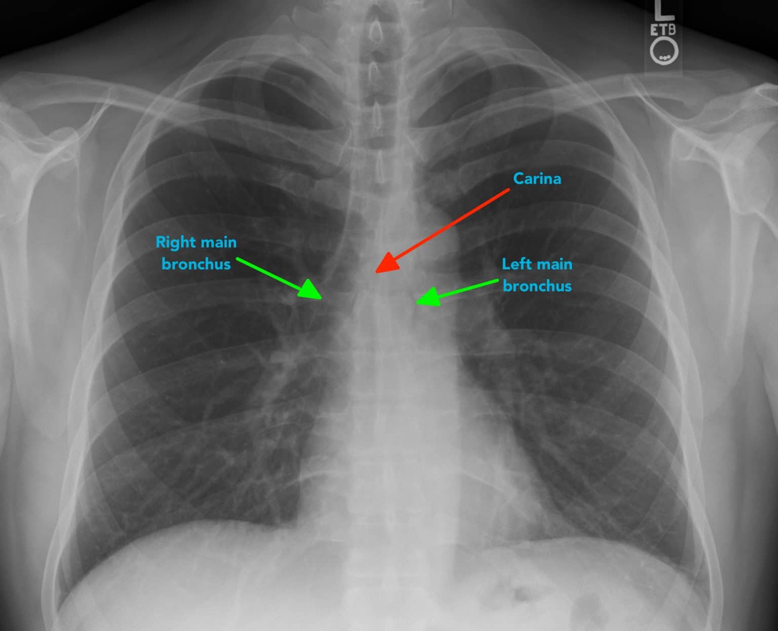 Chest X Ray Interpretation Guide Made Easy