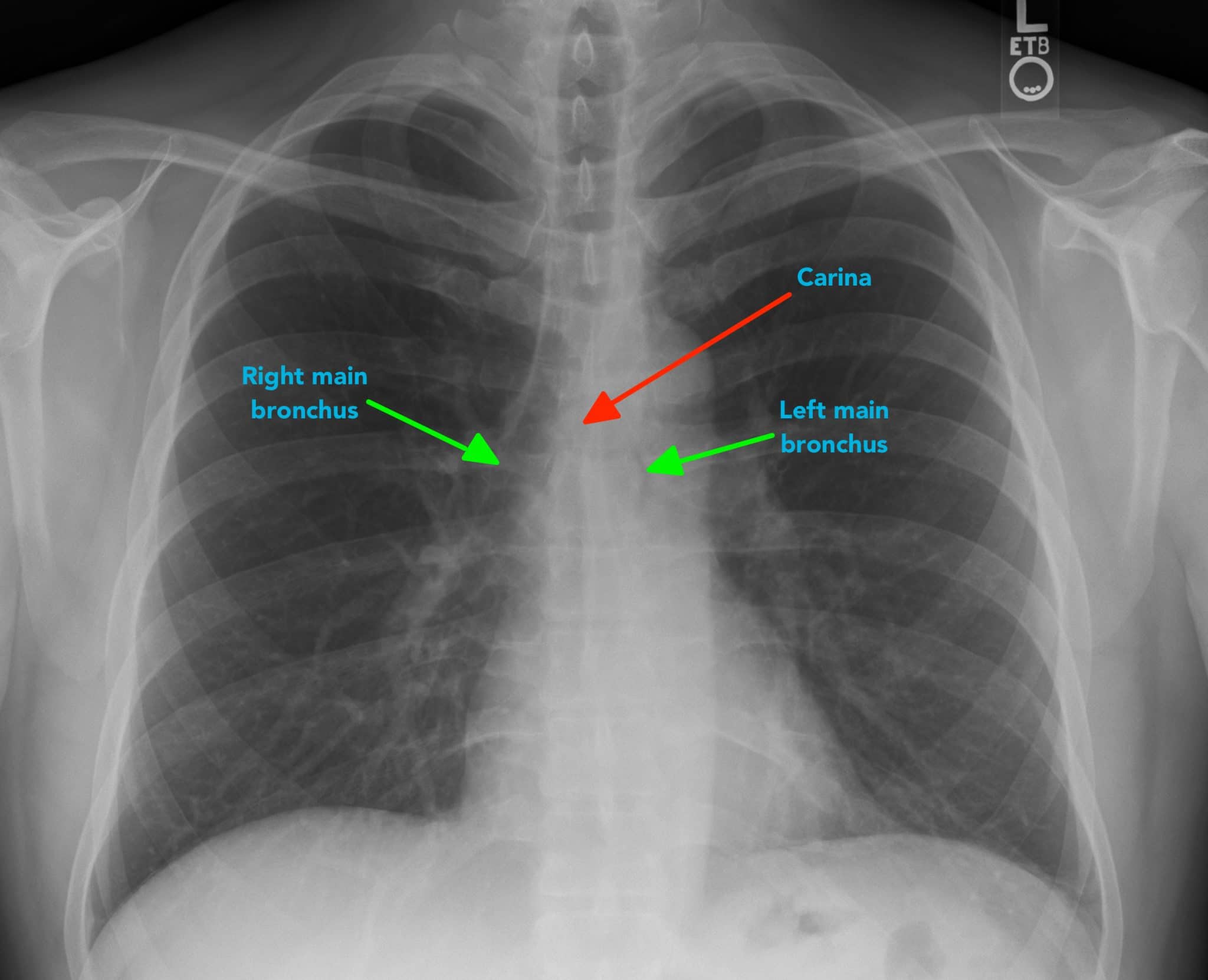 Chest X Ray Interpretation A Structured Approach Radiology Osce