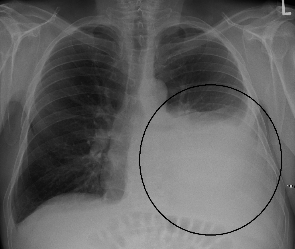 chest xray normal vs abnormal
