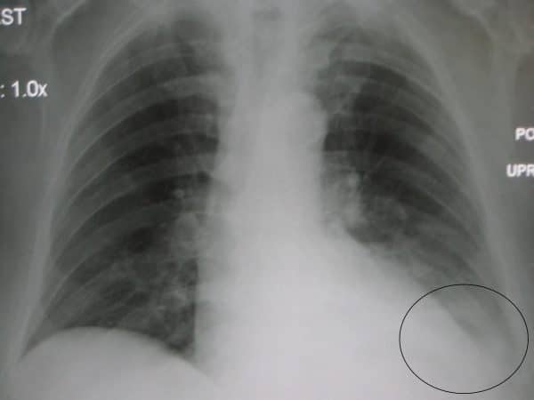 Costophrenic blunting secondary to pneumonia2