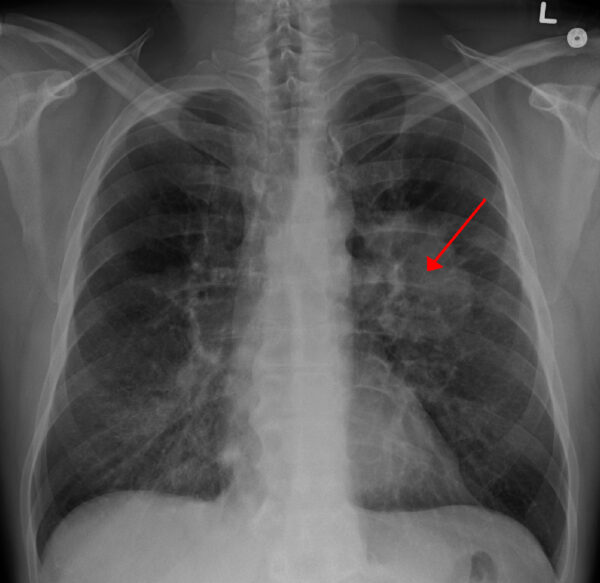 Lung tumour
