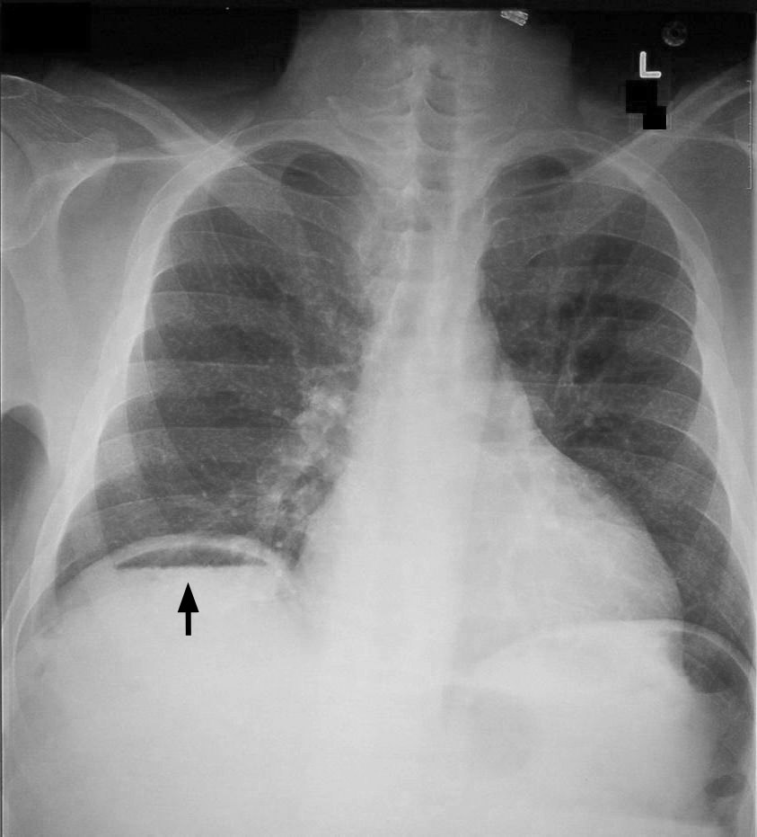 How To Write Normal Chest X Ray Report Example Of A Business Pdf