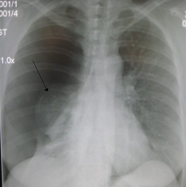 Right sided pneumothorax