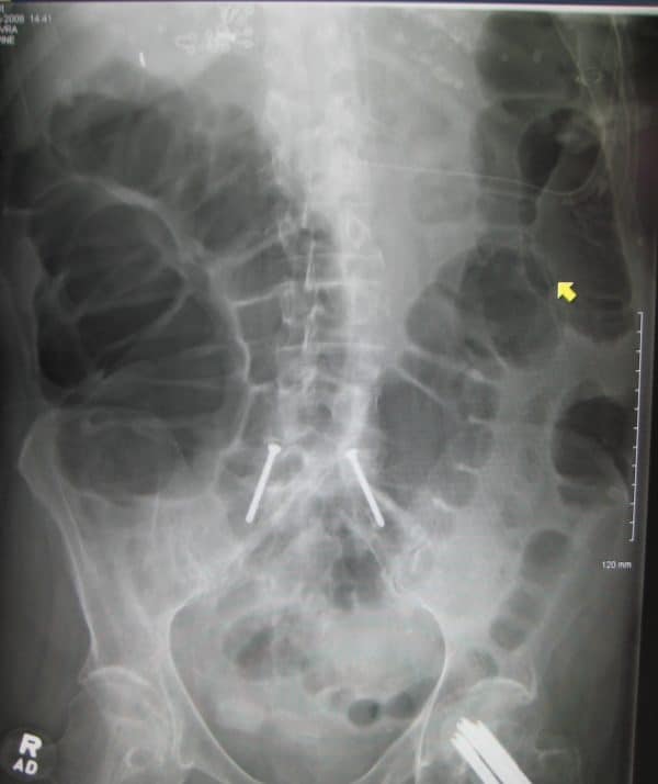 Large bowel obstruction (AXR)