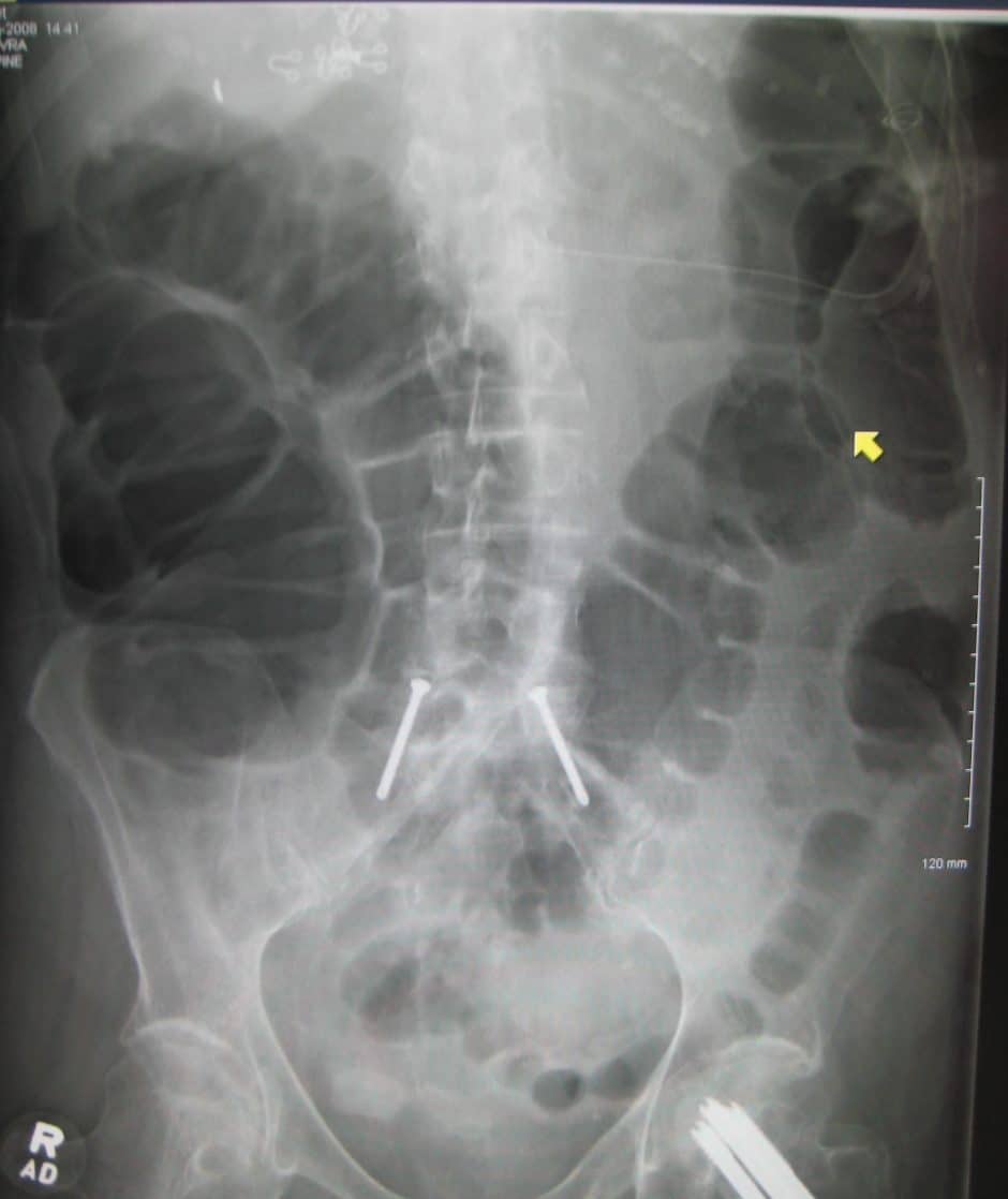 Abdominal Xray Interpretation (AXR) Radiology OSCE