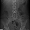 Abdominal x-ray belly button