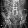 Normal Abdominal X-ray (AXR)