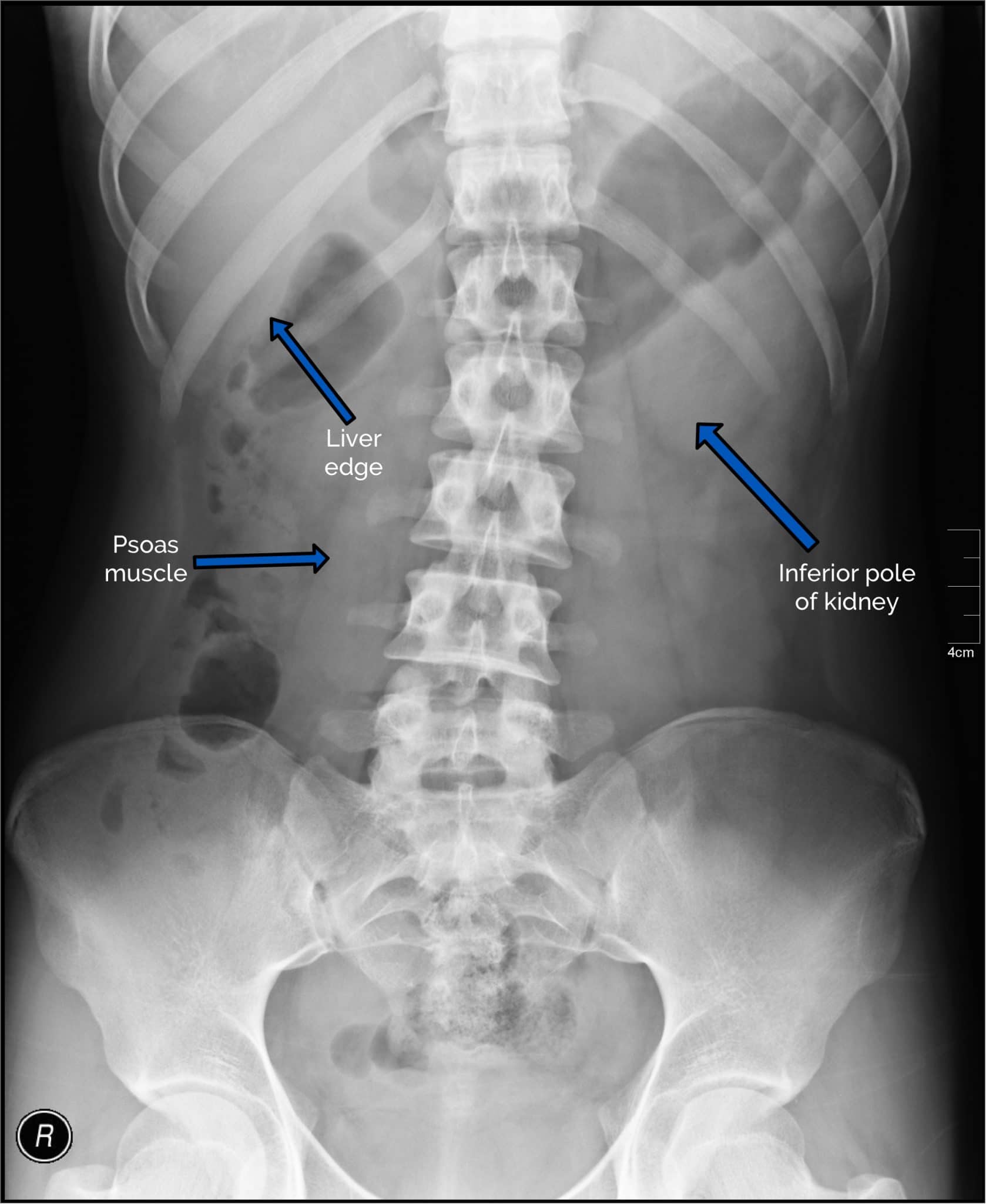 Abdominal X Ray Interpretation AXR Radiology OSCE Geeky Medics