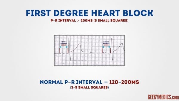 ECG - First-degree AV block