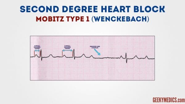 ECG - Second-degree AV block (Mobitz Type 1 - Wenckebach)