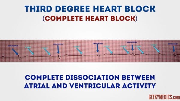 Complete heart block (3rd degree)