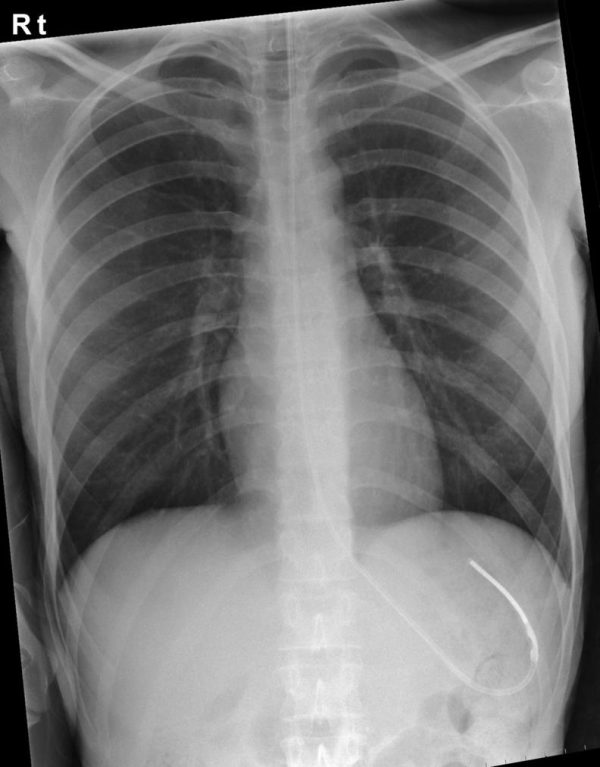 NG tube placement chest X-ray