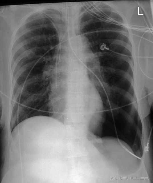 Incorrectly placed NG tube chest x-ray
