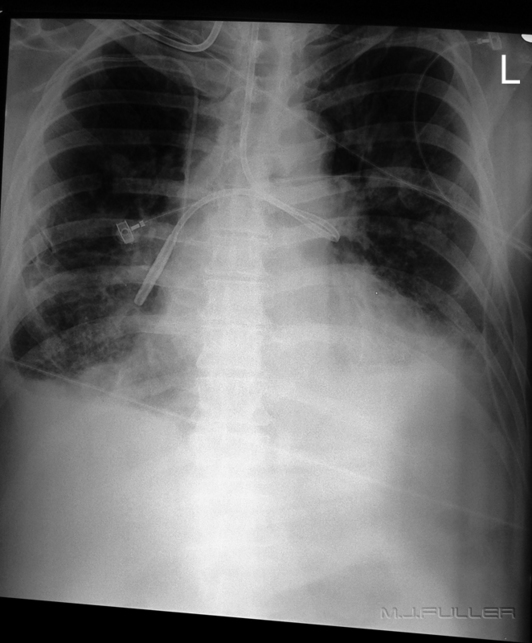Incorrectly place NG tube chest x-ray