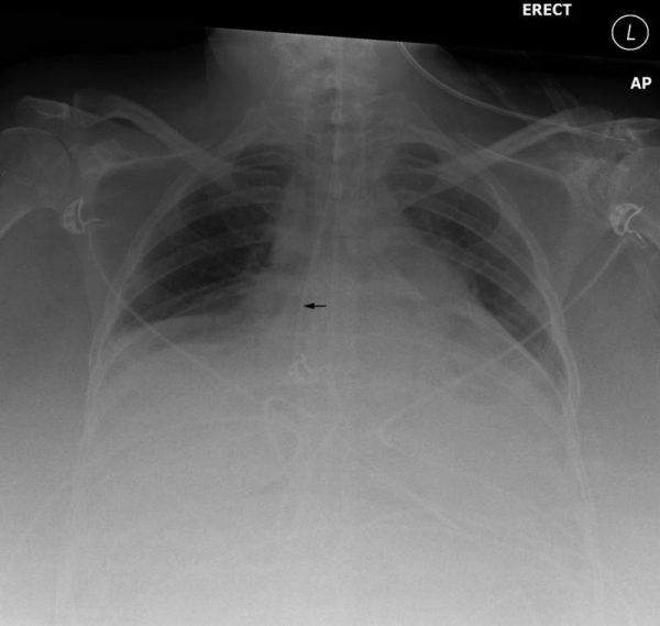 Ng tube chest x-ray