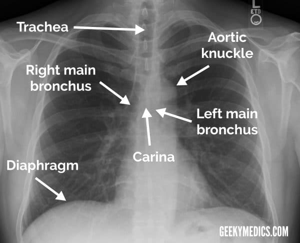 Normal chest x-ray annotated
