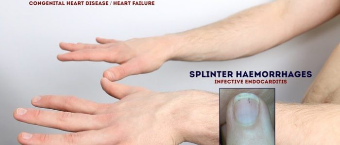 Splinter haemorrhages