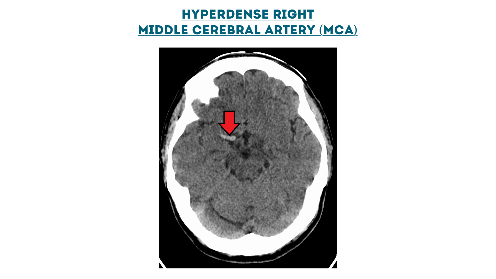 Figure 13 : Hyperdense right middle cerebral artery (MCA)