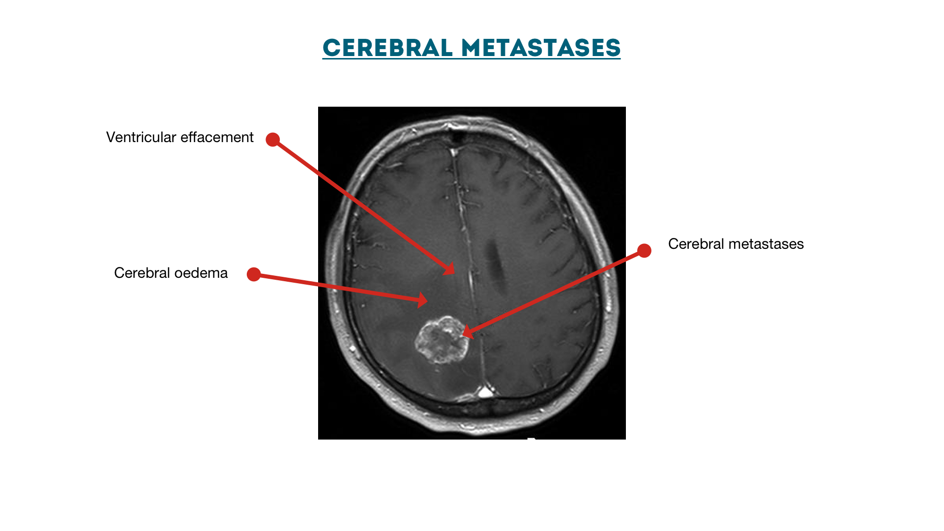 Figure 12 : Cerebral metastases with oedema