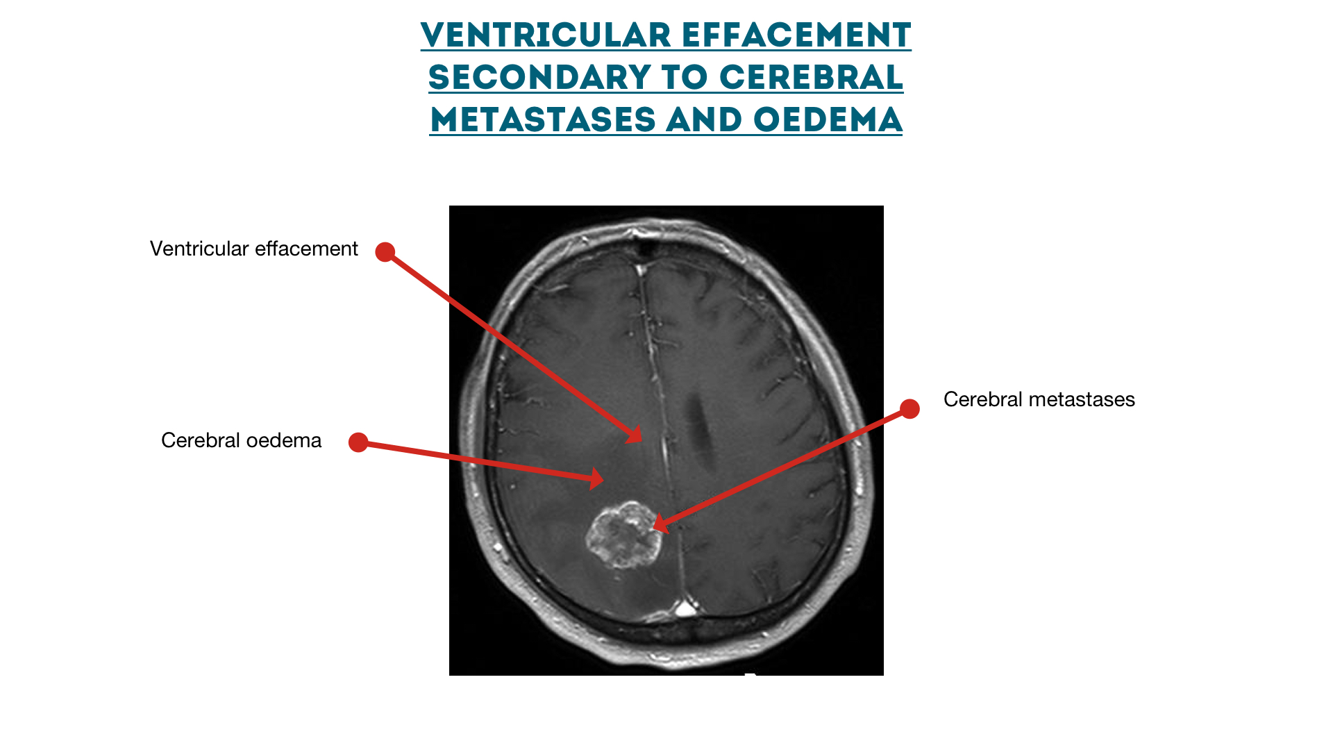 Figure 17 : Ventricular effacement secondary to cerebral metastases
